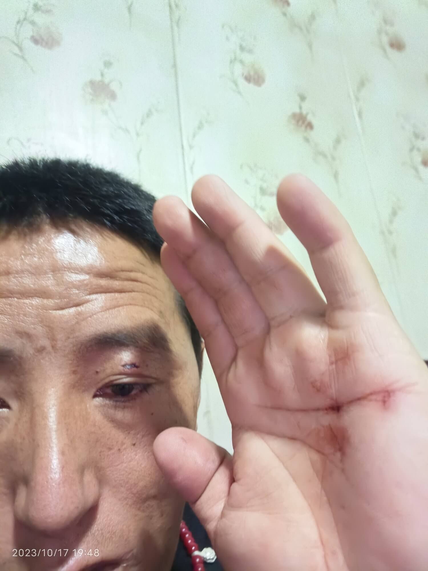 Bruise marks on hand and eye sustained by Tashi Wangchuk from beatings at Yushu Public Security Bureau